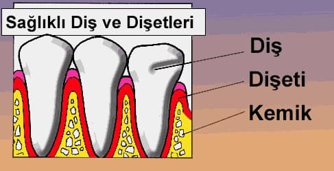 “Dişeti hastalıkları (peridontal hastalıklar)” görseli